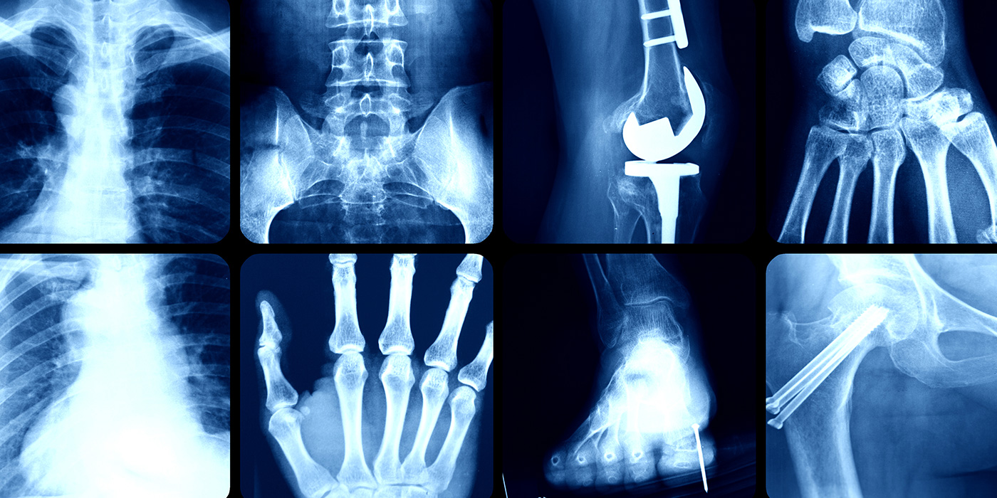 Using Calcium Phosphate to Heal Bone Defects